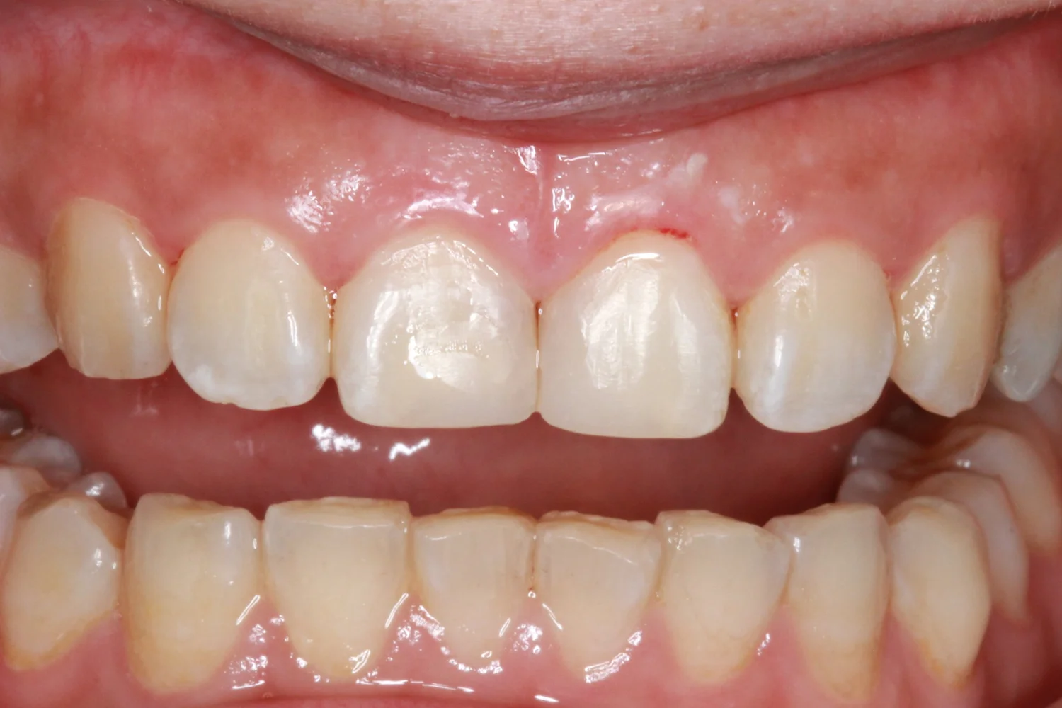 Upper front teeth after composite restoration, with the treated edges forming a more even contour.