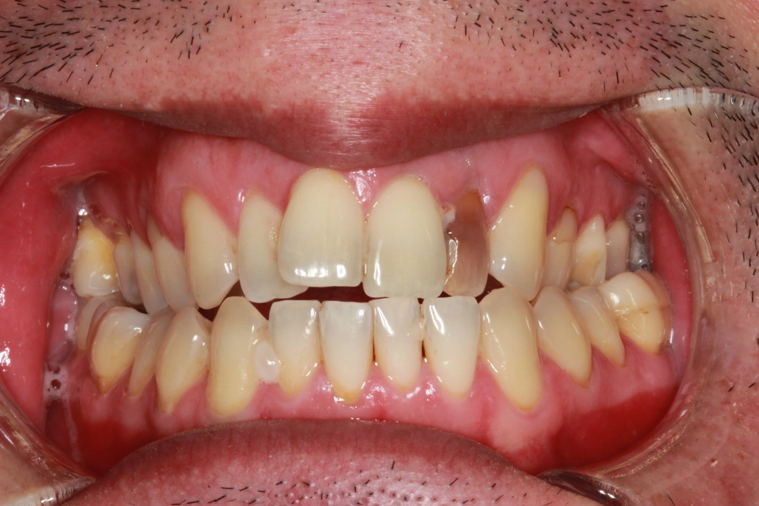 Upper front tooth with marked discolouration before crown treatment.