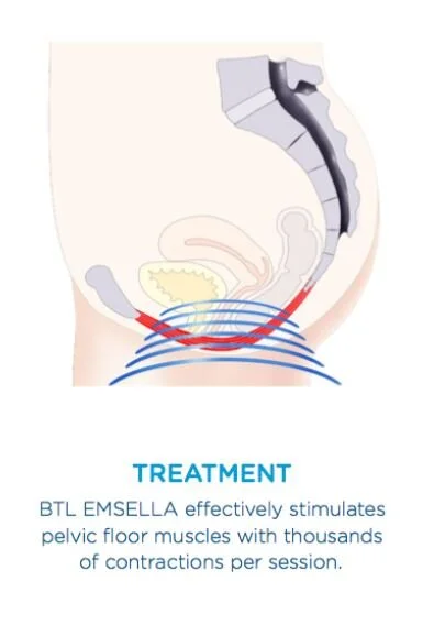 The Treatment That’s a Major Game Changer for Those With Urinary Incontinence