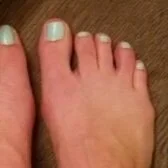 MY CORRECT TOES JOURNEY, PART 1