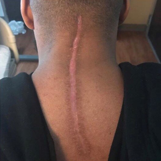 spinal scar.jpg