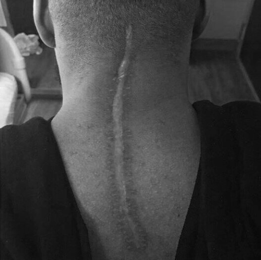 spinal+scar.jpg