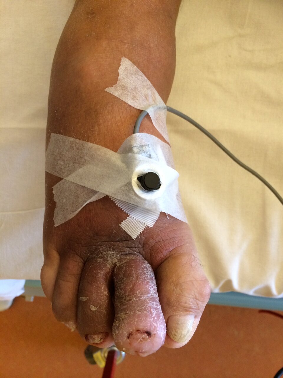 Diabetic foot with wound - measuring BFR.