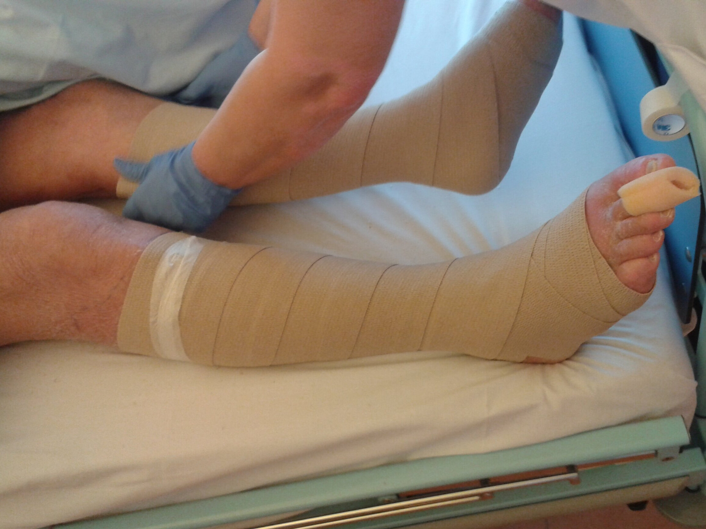 Erysipelas - mounting compression bandage.