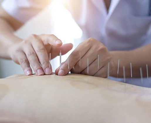 Acupuncture & Dry Needling 