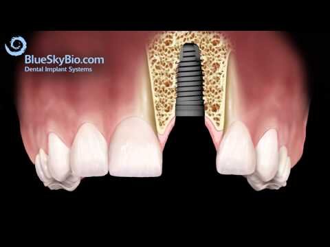 DENTAL IMPLANTS