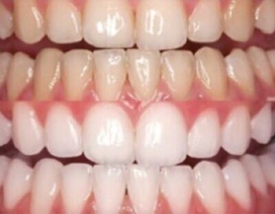 Teeth whitening with Boutique