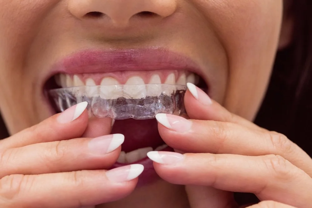 Person inserting a transparent Invisalign aligner onto their teeth