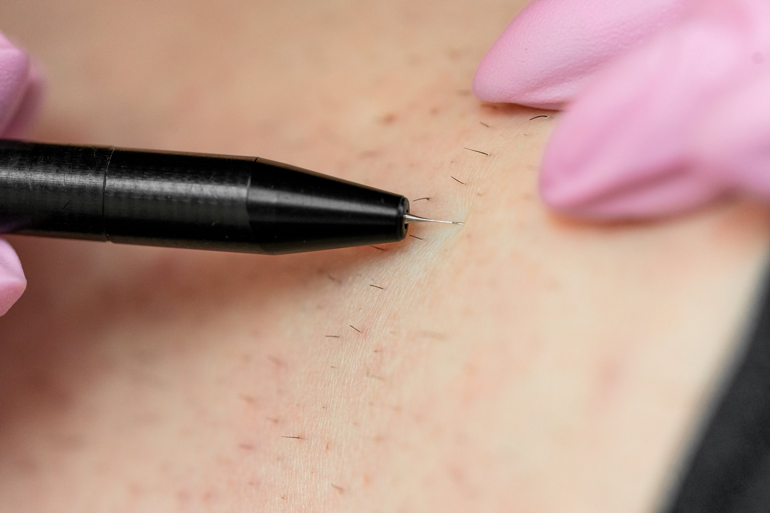 Electrolysis probe being inserted into the hair follicle at The Dreamhouse in Savannah, Georgia.