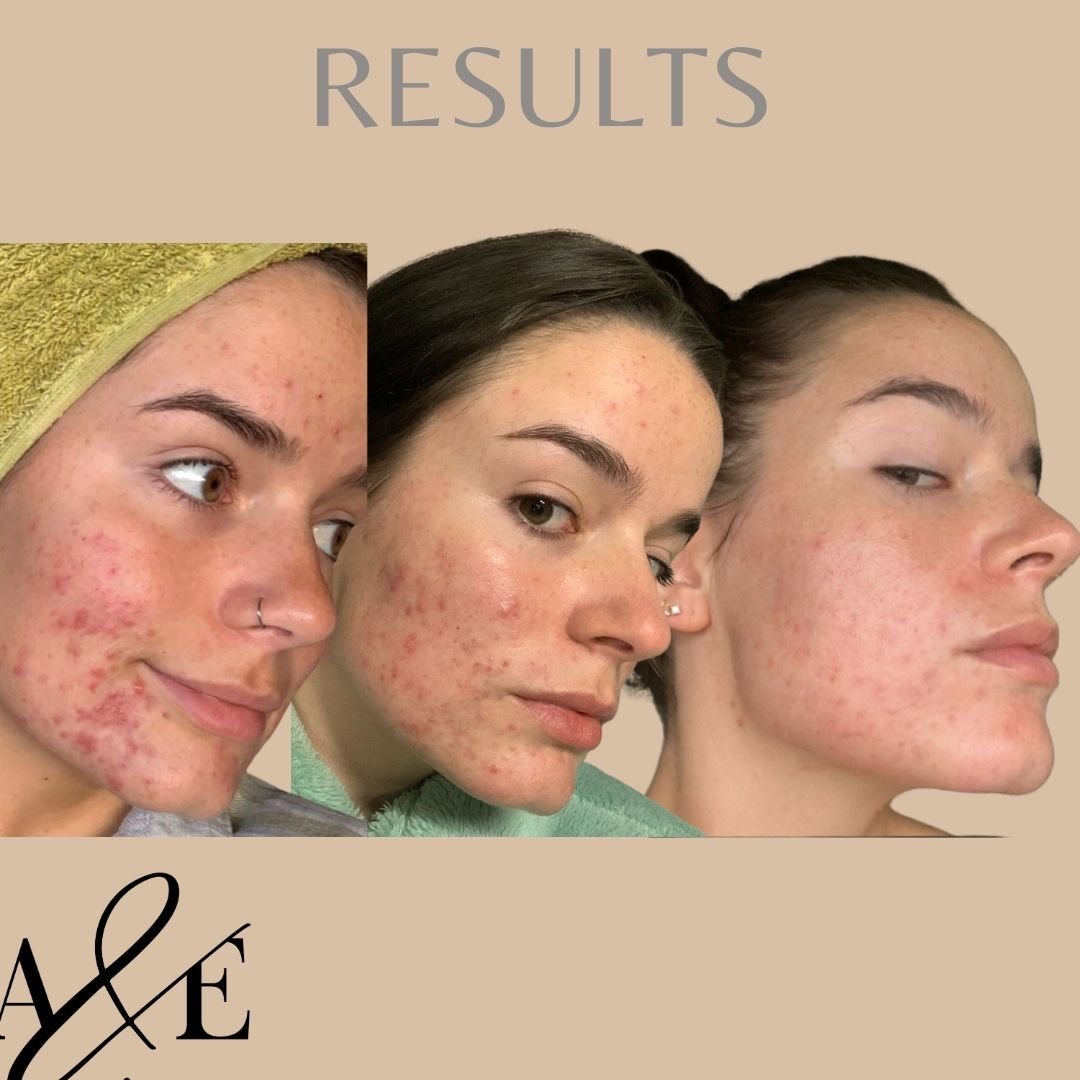 Enough before and afters - let's show the journey of progress in acne!
Sometimes progress is fast, sometimes it's slower.
Comparing your journey to anyone else's but yours could result in feeling a little disheartened.
Remember, progress is also depe