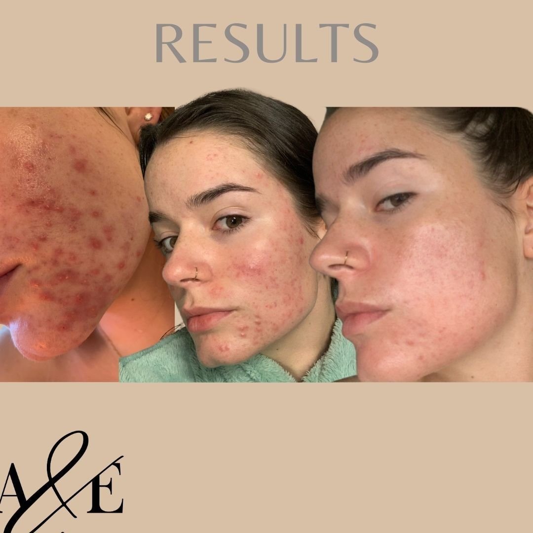 Last shot of this acne progress. So proud of this beautiful patient. 
We worked through gut, stress, sleep, diet, hormones. 
My favourite thing is she writes on her progress photos what part of the cycle she's in (follicular, luteal, ovulation). 
Get
