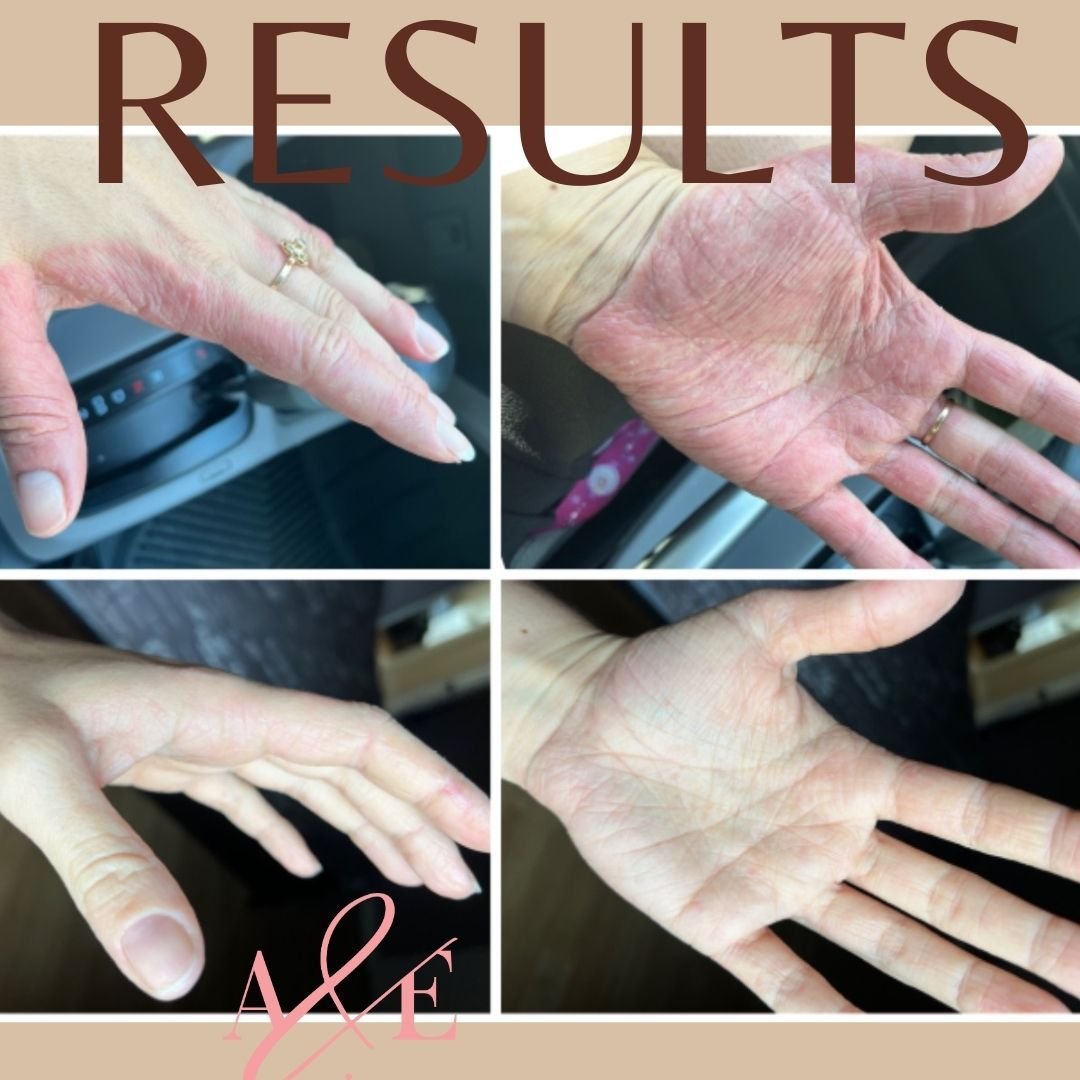 This beautiful patient lives in Canada and she takes a couple of capsules per day to maintain her amazing improvements and keep her barrier healthy and happy.
She used to have to wear gloves - in fact, she had been doing this for months at the time w