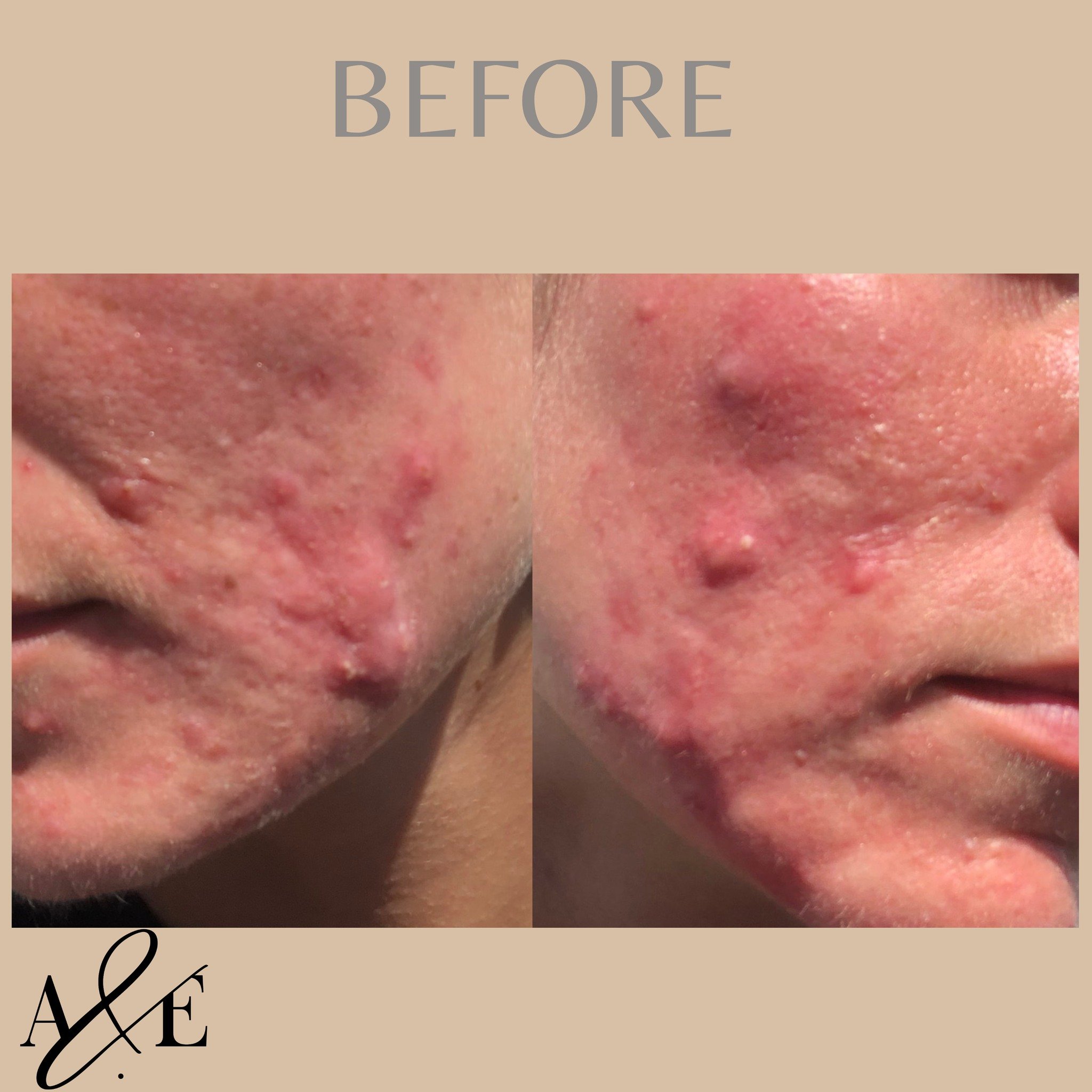 Just one month.
This babe was ready for help with her skin.
She went deep, did the work, was diligent with her prescription and what a change.

You know where we are.

 #skinhealth #AcneSupport #SkinBarrierHealth #SkinBarrierRepair #AdultAcne #stress