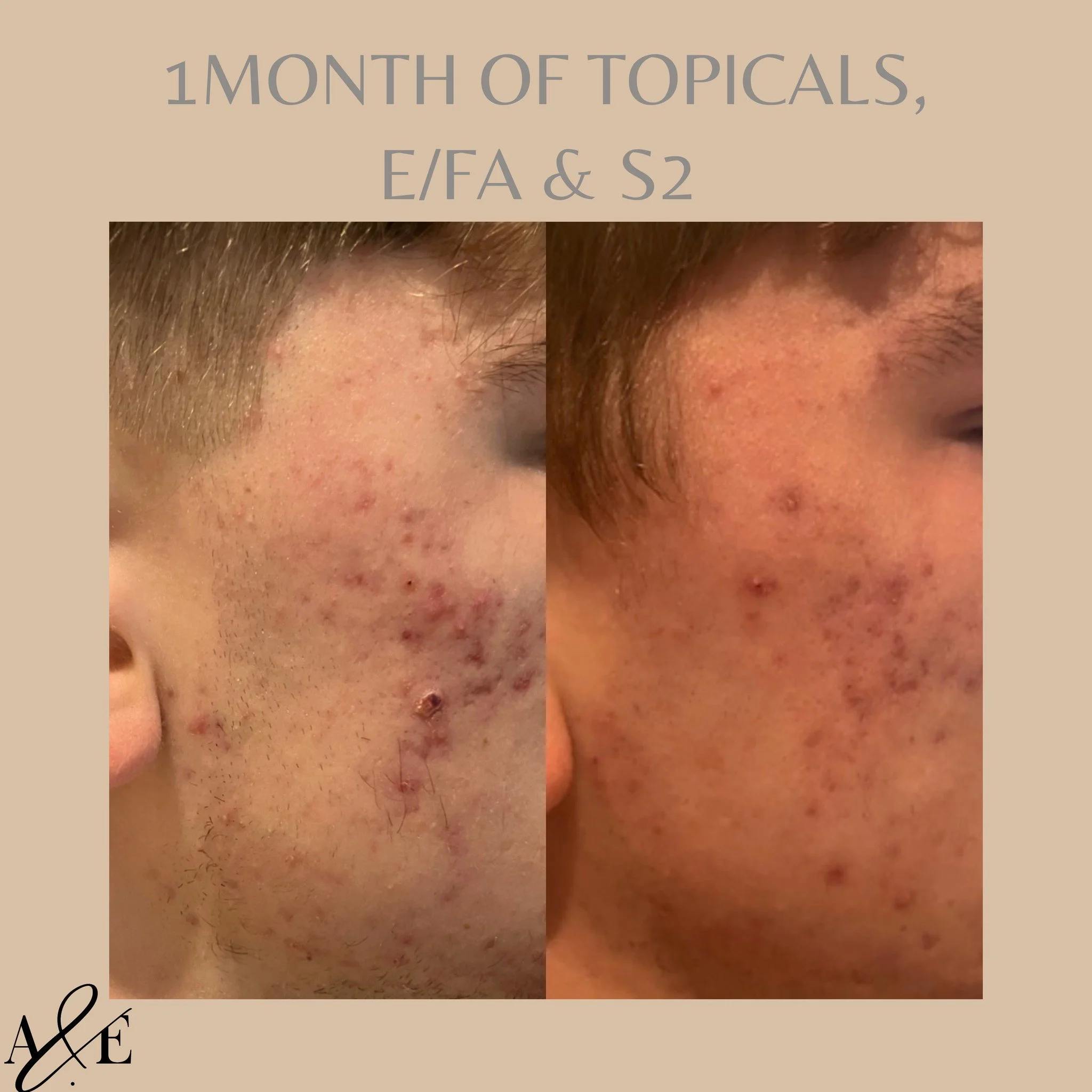 Using Dermaviduals customised skincare + our two signature products for skin: E/FA Pure high quality fish oil + Formula S2 with marine collagen peptides, we can already see a really positive change in this skin.
Healing time improved.
Less actives.
S