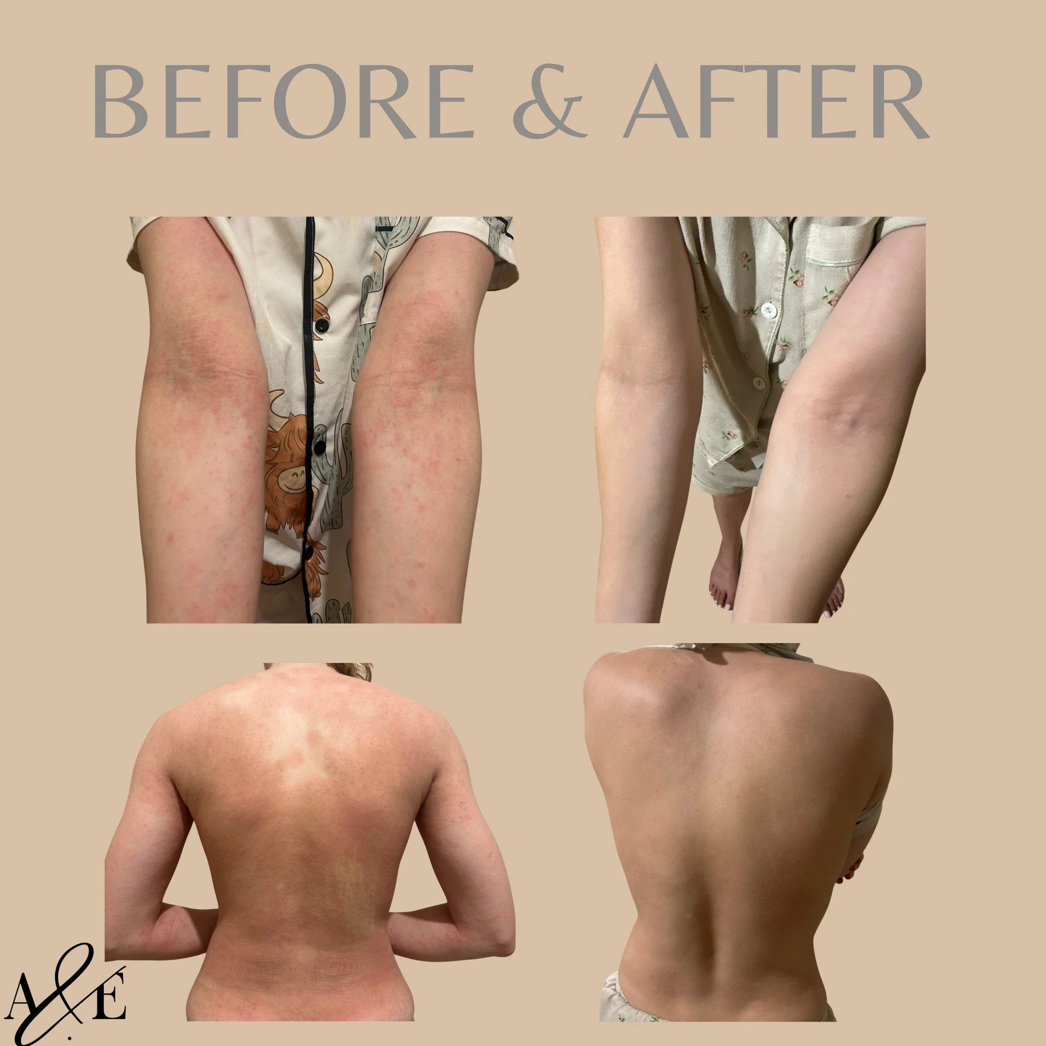 ⏰Timeframe: October 2025-February 2026.
💉Step 1: Determine underlying drivers with blood testing including IgE, hormones, zinc, iron, cortisol, white blood cells and case taking.
📝Step 2: Present the Report of Findings outlining the why, the prescr