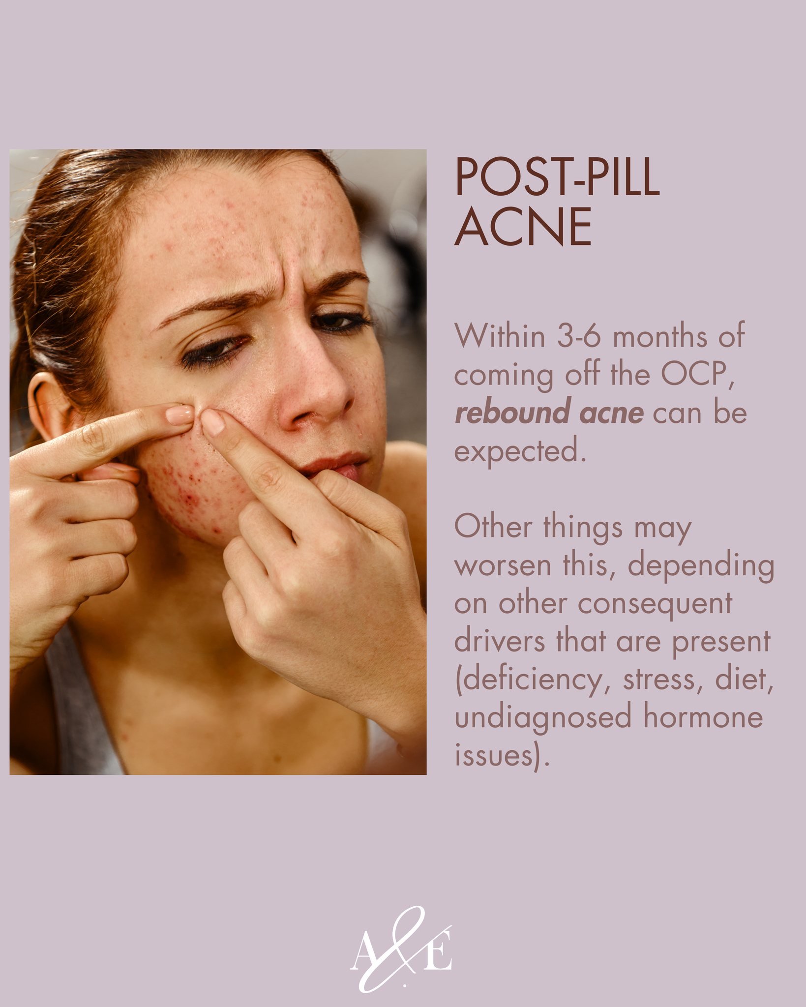 Don't panic - we've got you.
Post-Pill Acne is a thing and sometimes you won't realise it's your thing, until 3-6 months after stopping the Pill.

 #postpillacne #hormonalacne #HormonalAcneHelp #hormonalacnehelp #hormonalacnetips #hormonalacnejourney