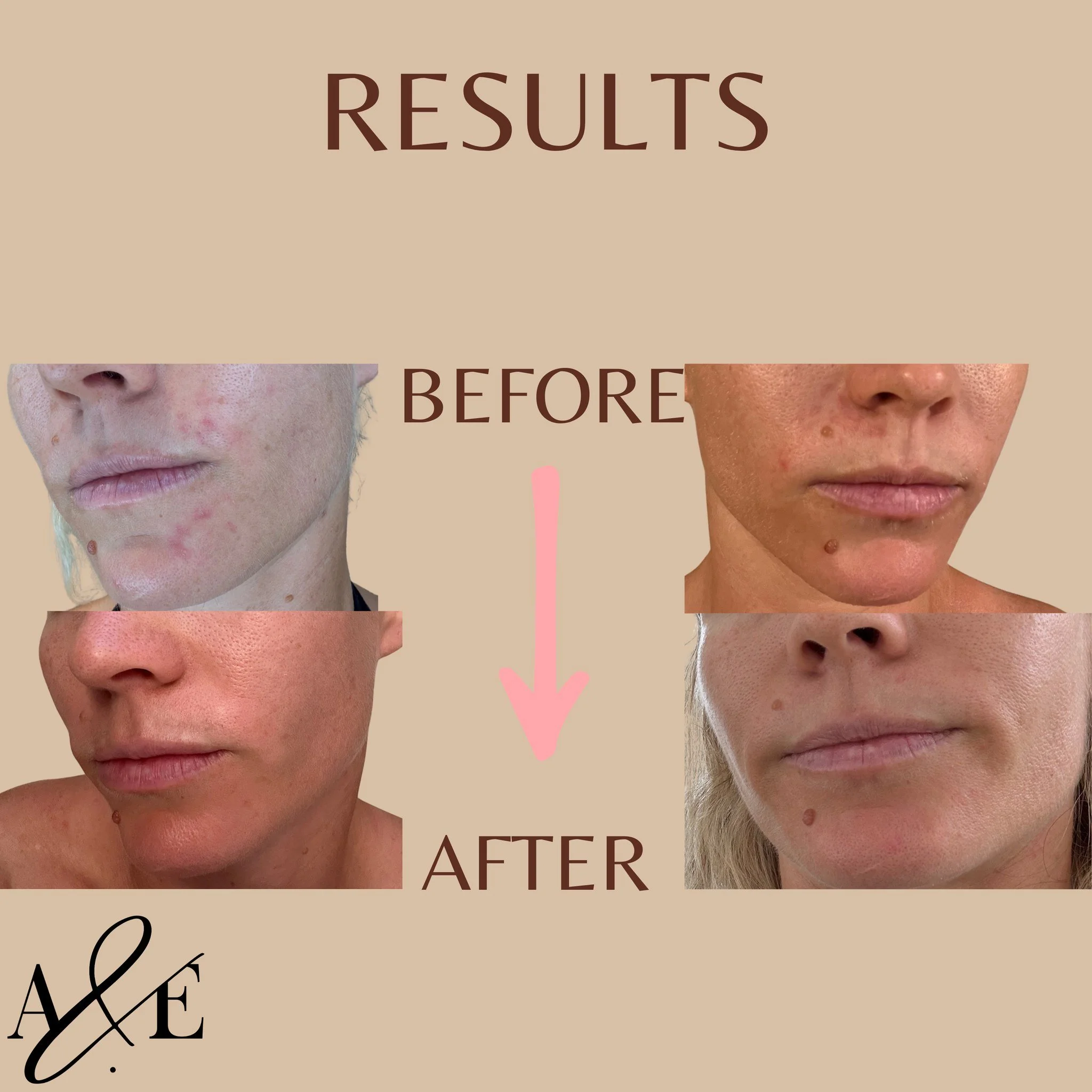 What a difference 3 months makes.
This beauty was experiencing perioral dermatitis so we created a plan that focused on stress, immune and nervous system support, nutrients to provide the skin what it was lacking and customised topicals from @dermavi