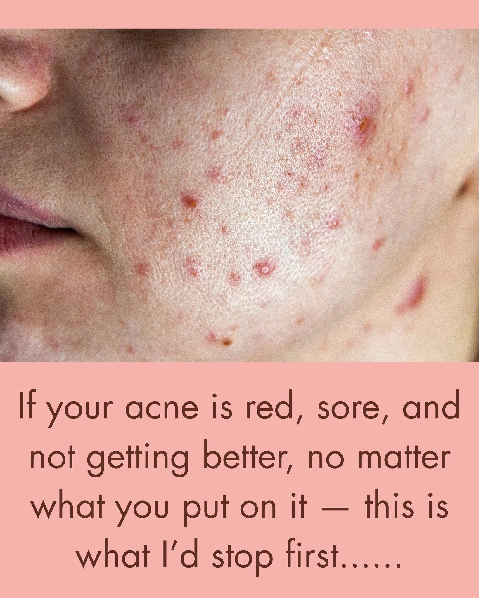 Are you making your skin worse?
1. Don't pick at it.
2. Stop trying to dry it out with products that make it worse!
3. Stop over-feeding it with a 12-step skincare routine that doesn't work for you babe.

We can help with the internal drivers and pro