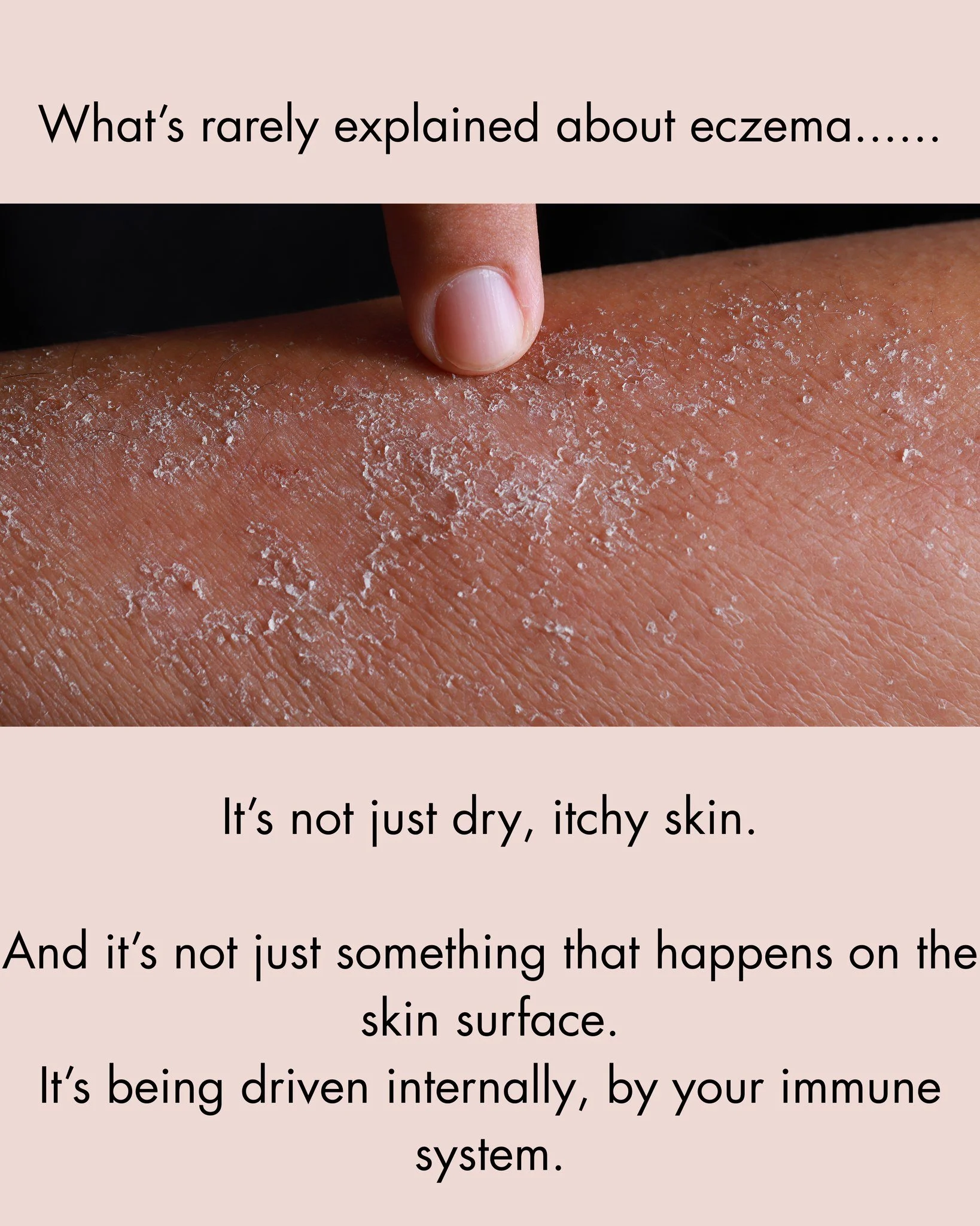 Using steroid creams might be necessary sometimes but it's not a great long term solution.
Understanding what's driving your eczema is fundamental to knowing how to treat it.

That's why we're different.

Packages &amp; Pay-As-You-Go options availabl