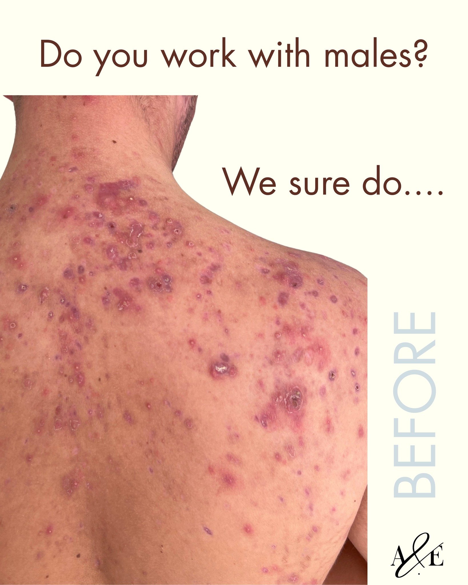 We work with everyone!
Skin is skin babe.
Our goal is to understand why your skin is causing you grief and then create a plan, prescribe what your body and skin needs, and educate you along the way.

You know where we are.

 #maleacne #Acne #acneskin