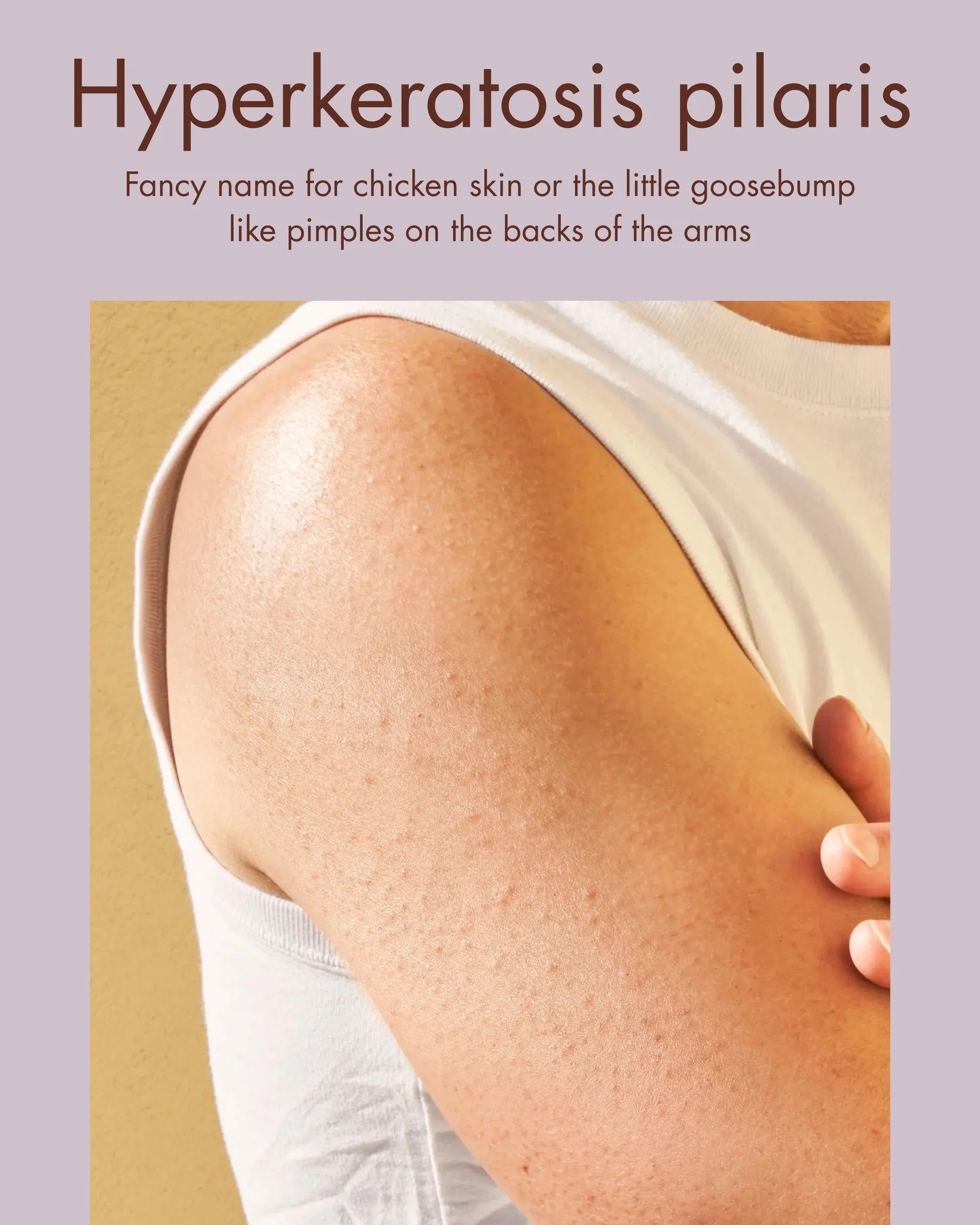 Hyperkeratosis pilaris is often mistaken for acne.
Gentle exfoliation (our Vitamin Exfoliant Crystals are a gentle but effective option) is useful but fixing the inner driver is 🔑
It could be a deficiency in Vitamin E or Vitamin A or even gluten int
