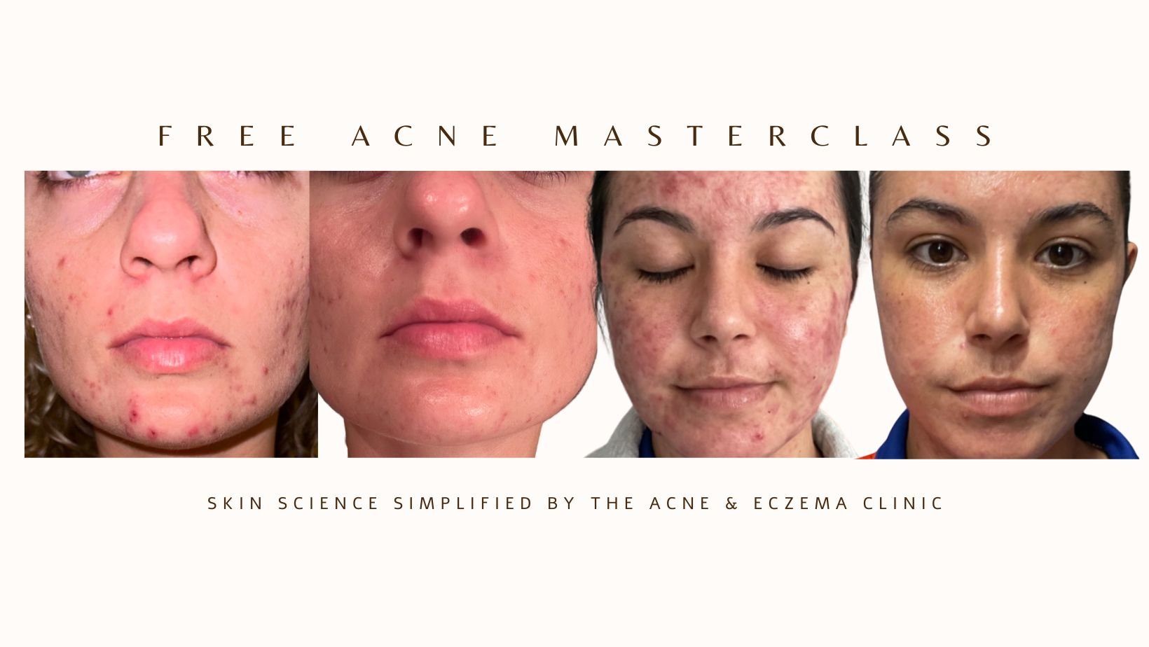 eczema facebook cover (2).jpg