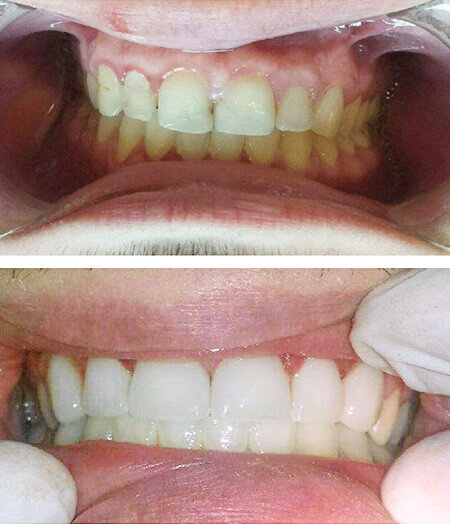 ogden-utah-dentist-smile-gallery11.jpg