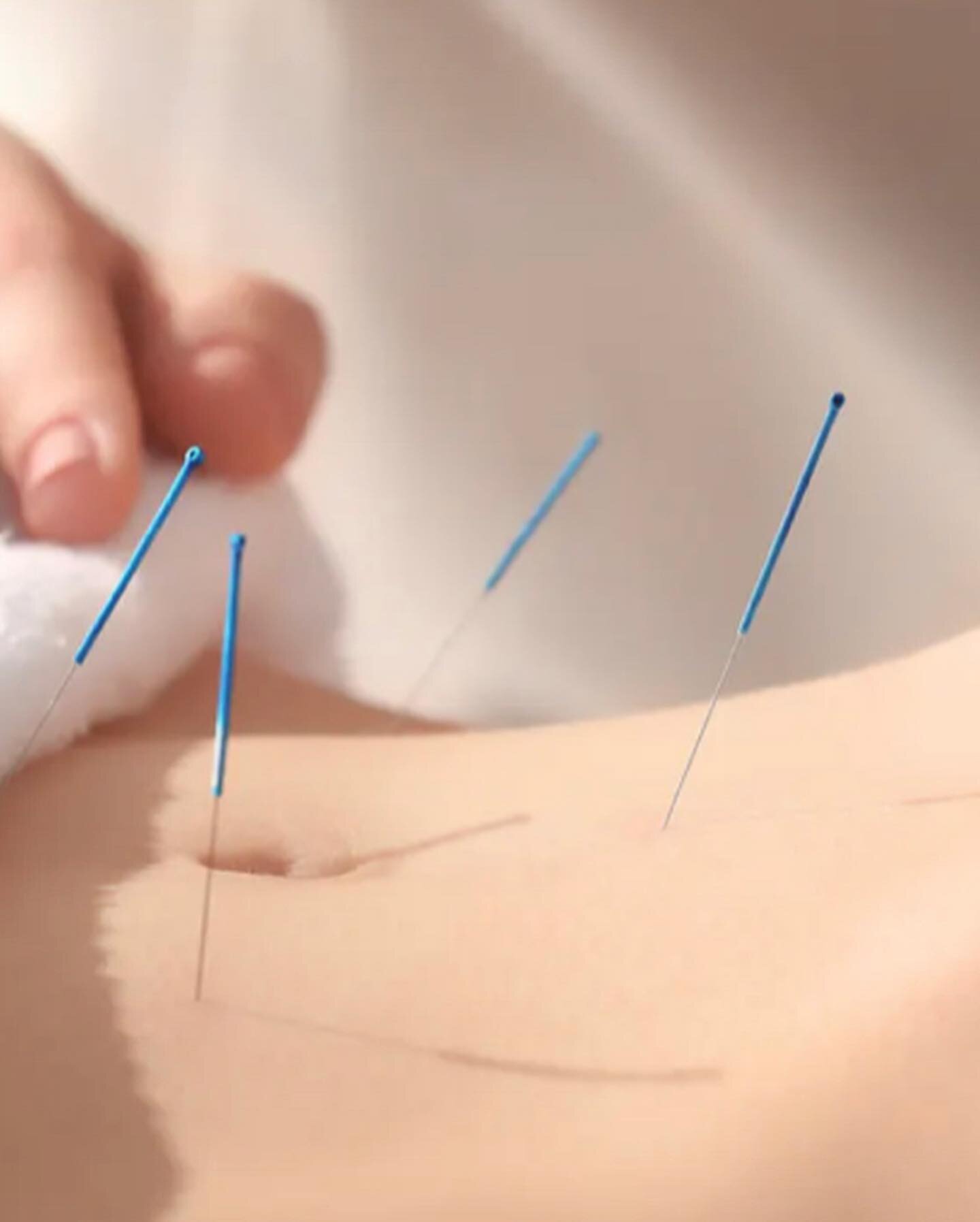 A win for ACUPUNCTURE and ENDOMETRIOSIS -related chronic pelvic pain sufferers!

Hot off the press is the results of a feasibility study on #acupuncture and #endometriosis.

Research found that acupuncture twice a week for 8 weeks was a safe and feas