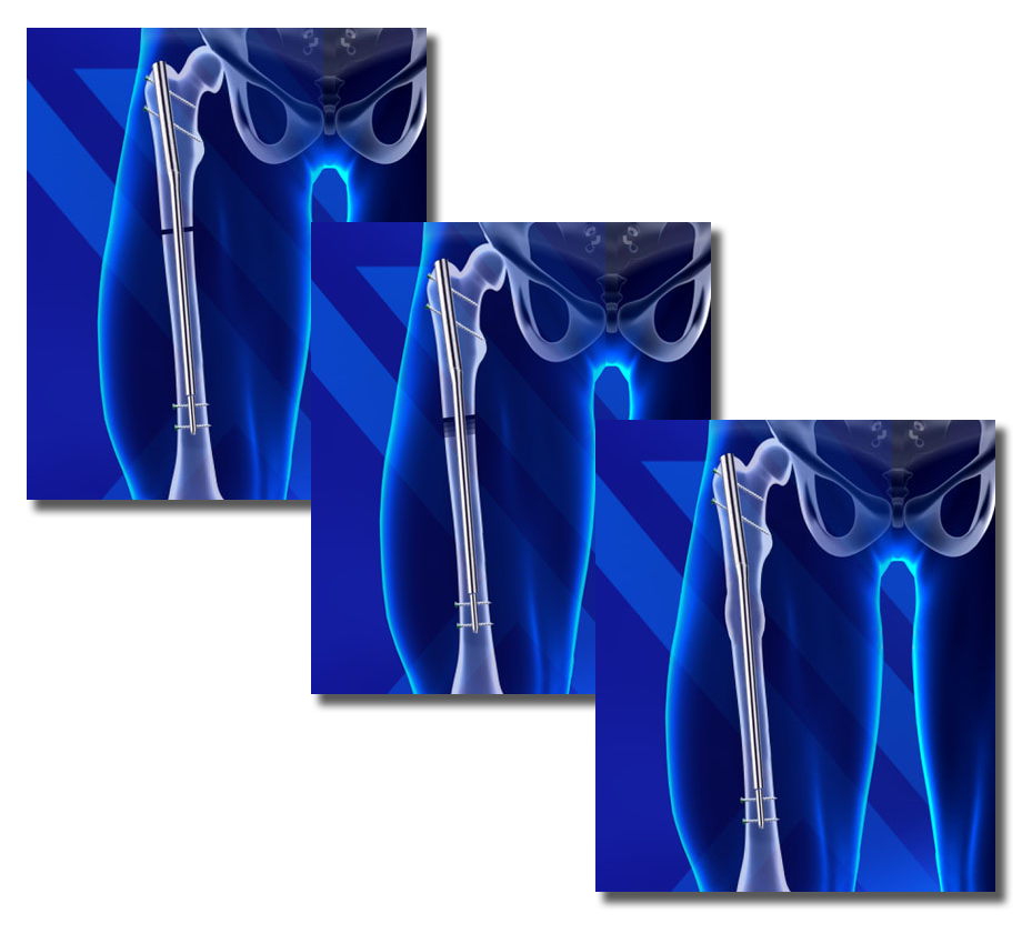 Precice System LimbplastX Institute | World Renowned Limb-Lengthening