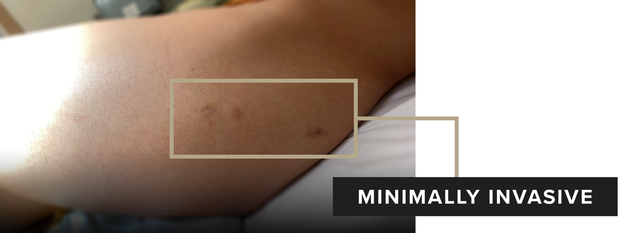 Limbplastx_Image(Surgery-After).png