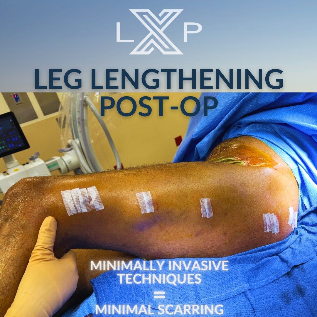 Curious about scarring following leg lengthening surgery? Our minimally-invasive surgical techniques result in minimal scars, just like in our latest patient! #medicalprogress #gettaller #limbplastxinstitute #limblengthening