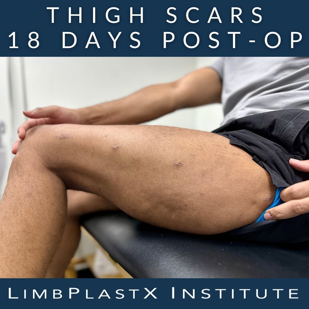 Check out the rapid healing of Jerry&rsquo;s thigh scars. Our inspiring #leglengthening advocate is just 18 days post-op and making incredible progress! Follow #limbplastxinstitute closely for more updates about Jerry&rsquo;s journey. #gettaller #min