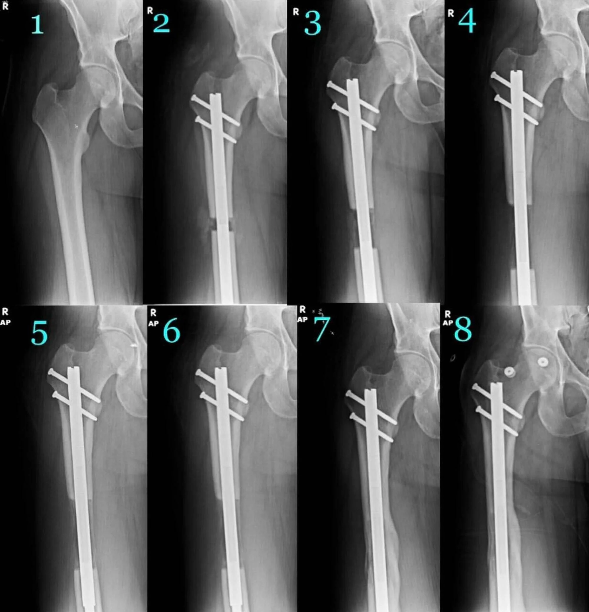 Surgeon Kevin Debiparshad Performs Leg-Lengthening Surgery