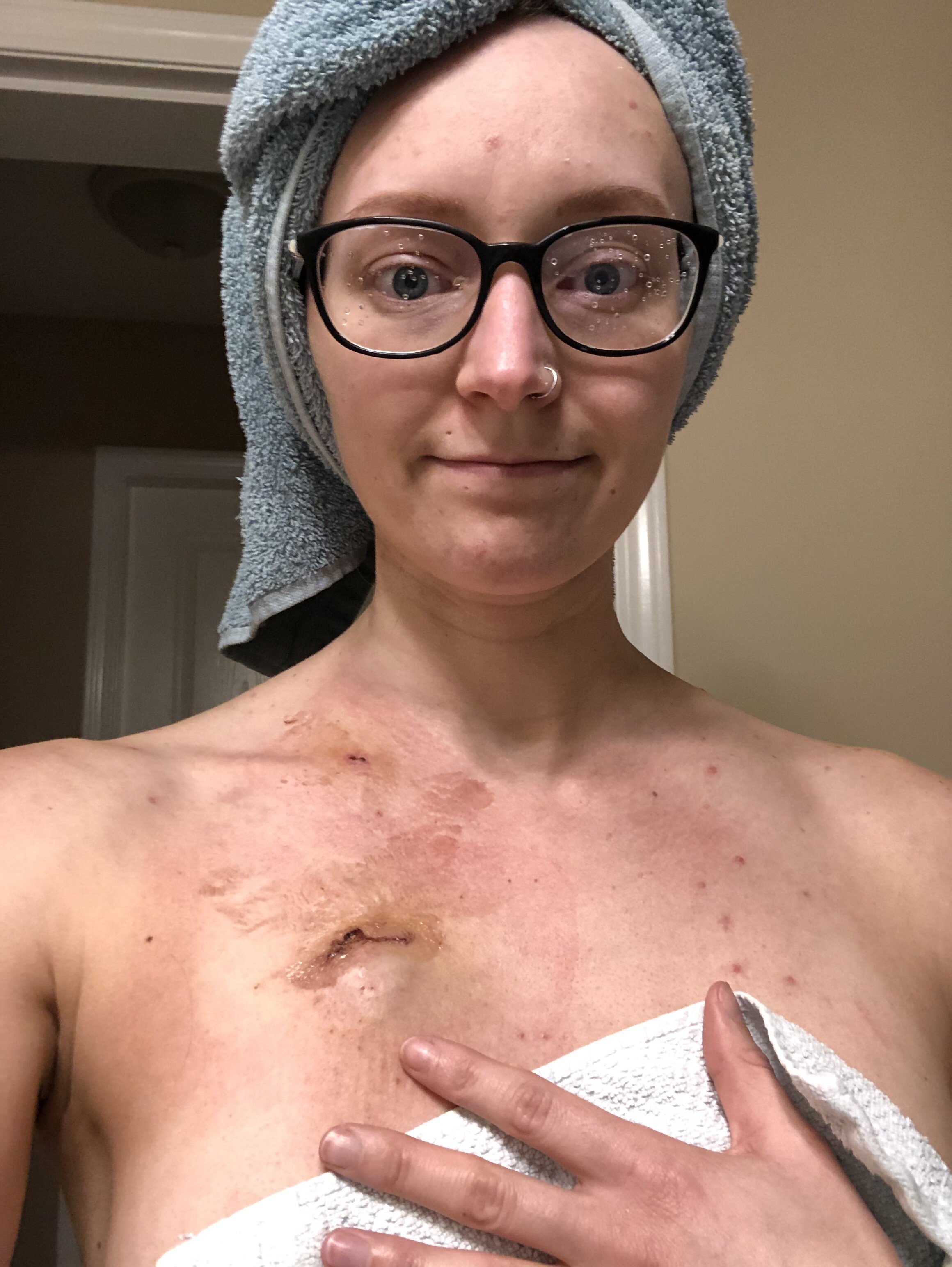 CHEMO PORT PLACEMENT PROCEDURE {VLOG} 