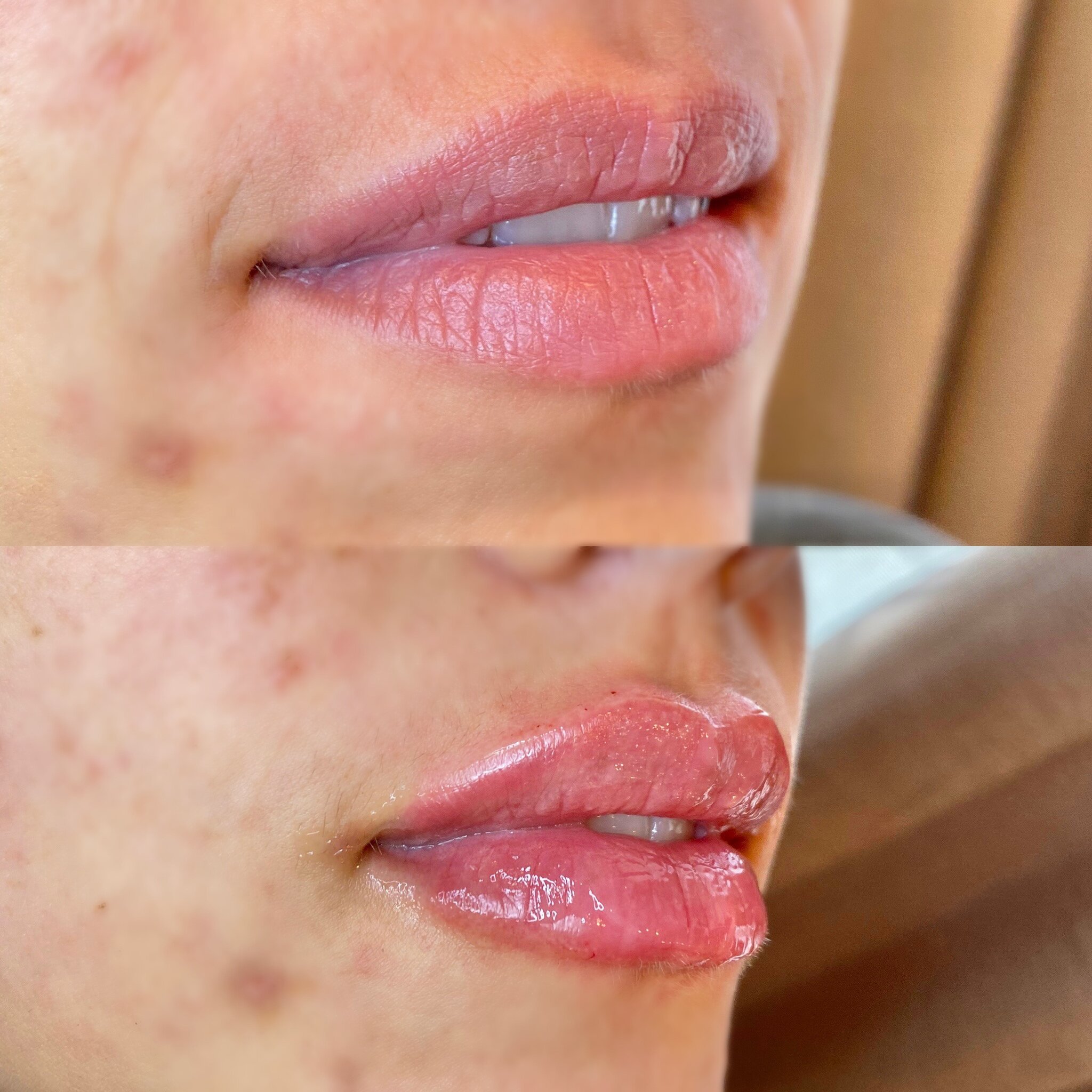 The Ultimate Guide to Understanding Facial Fillers 1 lip filler side view.jpeg