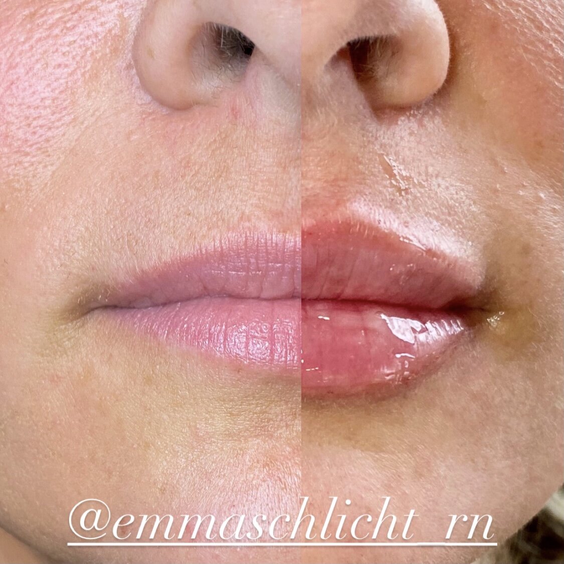 The Ultimate Guide to Understanding Facial Fillers 2 lip filler.jpeg