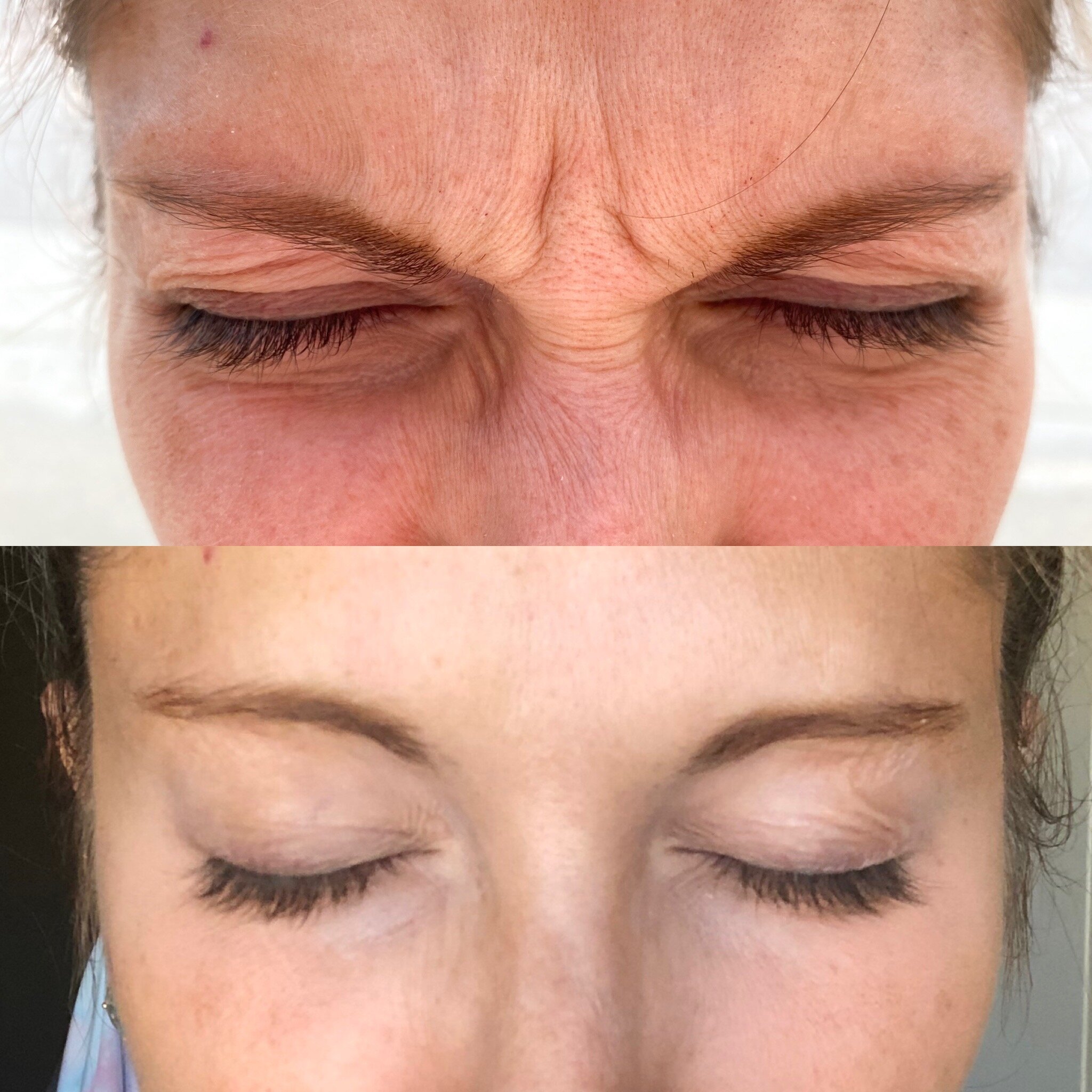 Botox/Dysport — Refresh Medical Spa