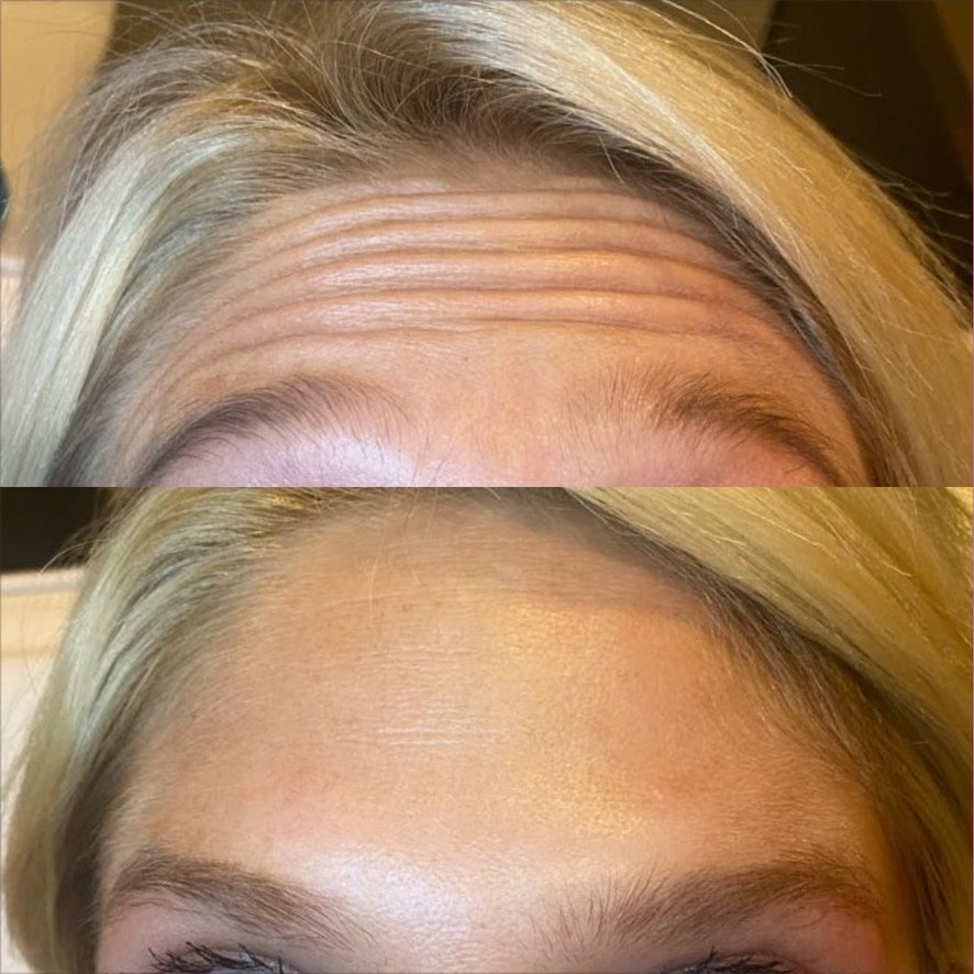 Botox/Dysport — Refresh Medical Spa