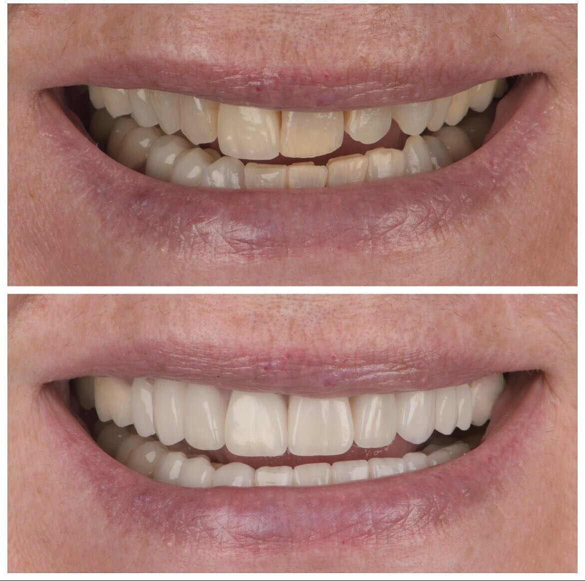 Check out this amazing smile transformation! This patient came to us unhappy with the appearance of her teeth and wanted a natural look with discreet whitening. 

@drsclafani restored her confidence by placing 19 beautiful crowns, addressed cracks, a