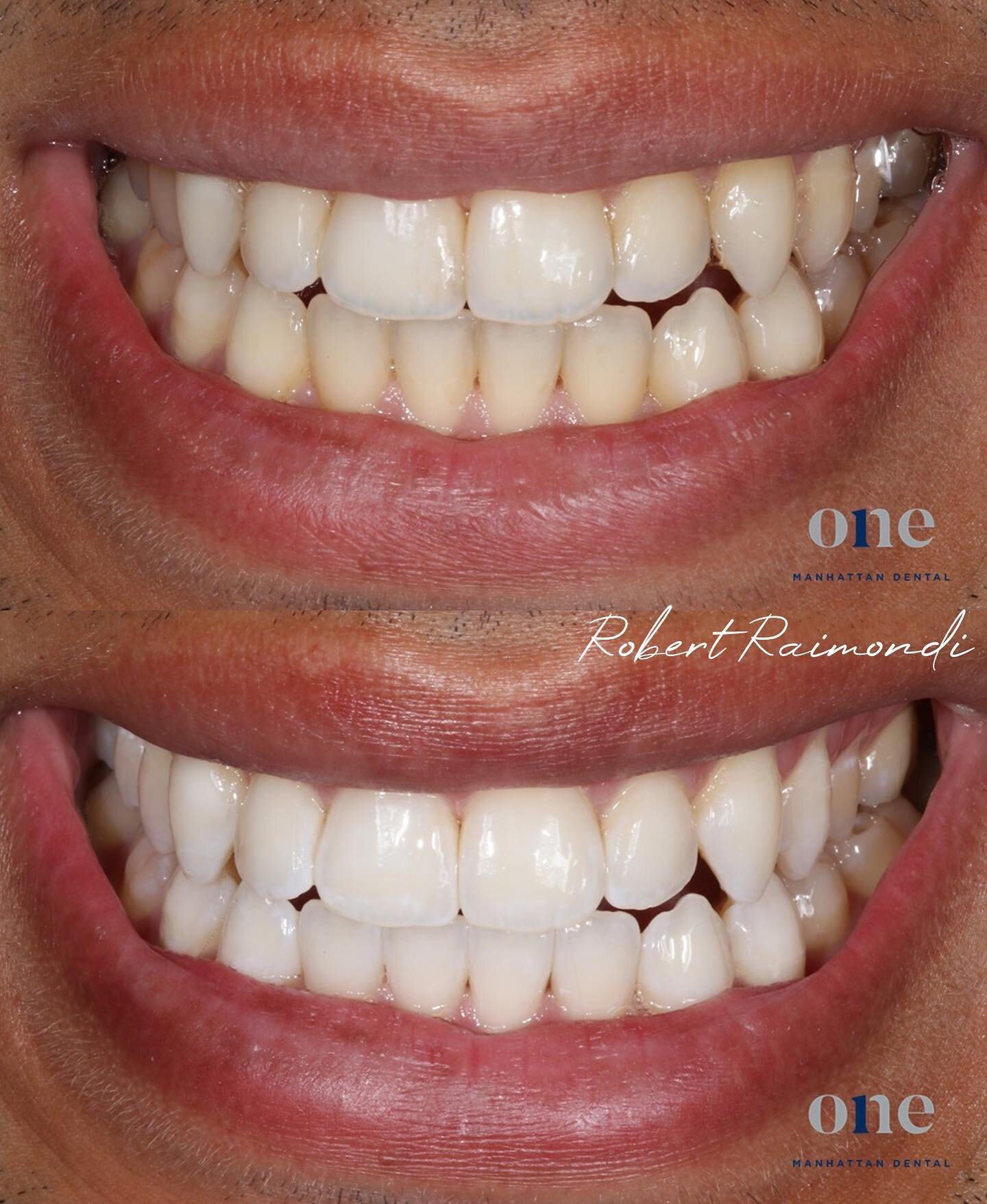 Brighter smiles for happier days! This patient came in for a whitening treatment. From the moment they stepped into our office, it was clear that their smile was about to undergo a remarkable transformation by @drraimondi. 

Now their teeth are brigh