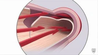Study: Cervical Spine HVLA Ineffective Against Cervical Arterial Dissection