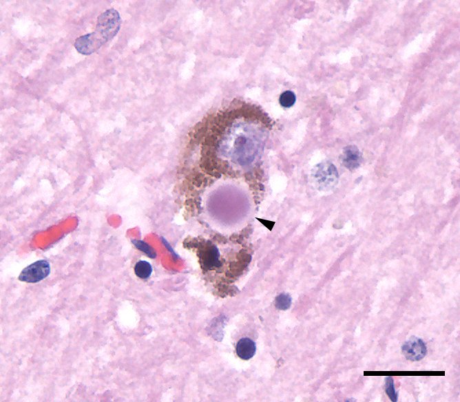 Genetics of Parkinson's Disease — Mary Bates, PhD