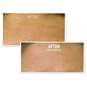 Hydrafacial-R-Vorher-Nachher-FaltenyHKkLKRKyXFE5.jpg