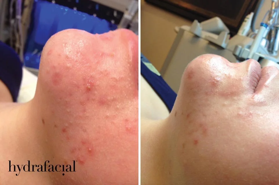 Hydrafacial-R-Vorher-Nachher-Akne.jpg