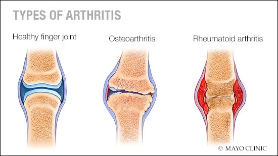 Soothing The Ache: How Physical Therapy Can Help Individuals with Arthritis