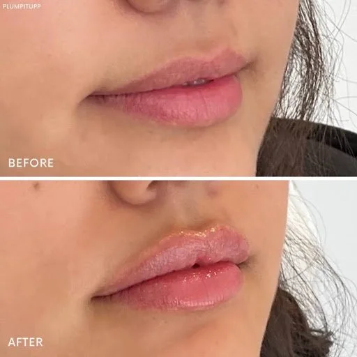 Lip flip before and after, glossy fuller volume
