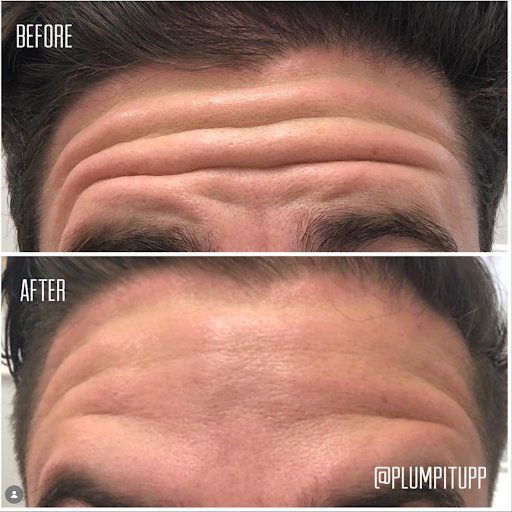 Forehead wrinkles before and after Dysport treatment