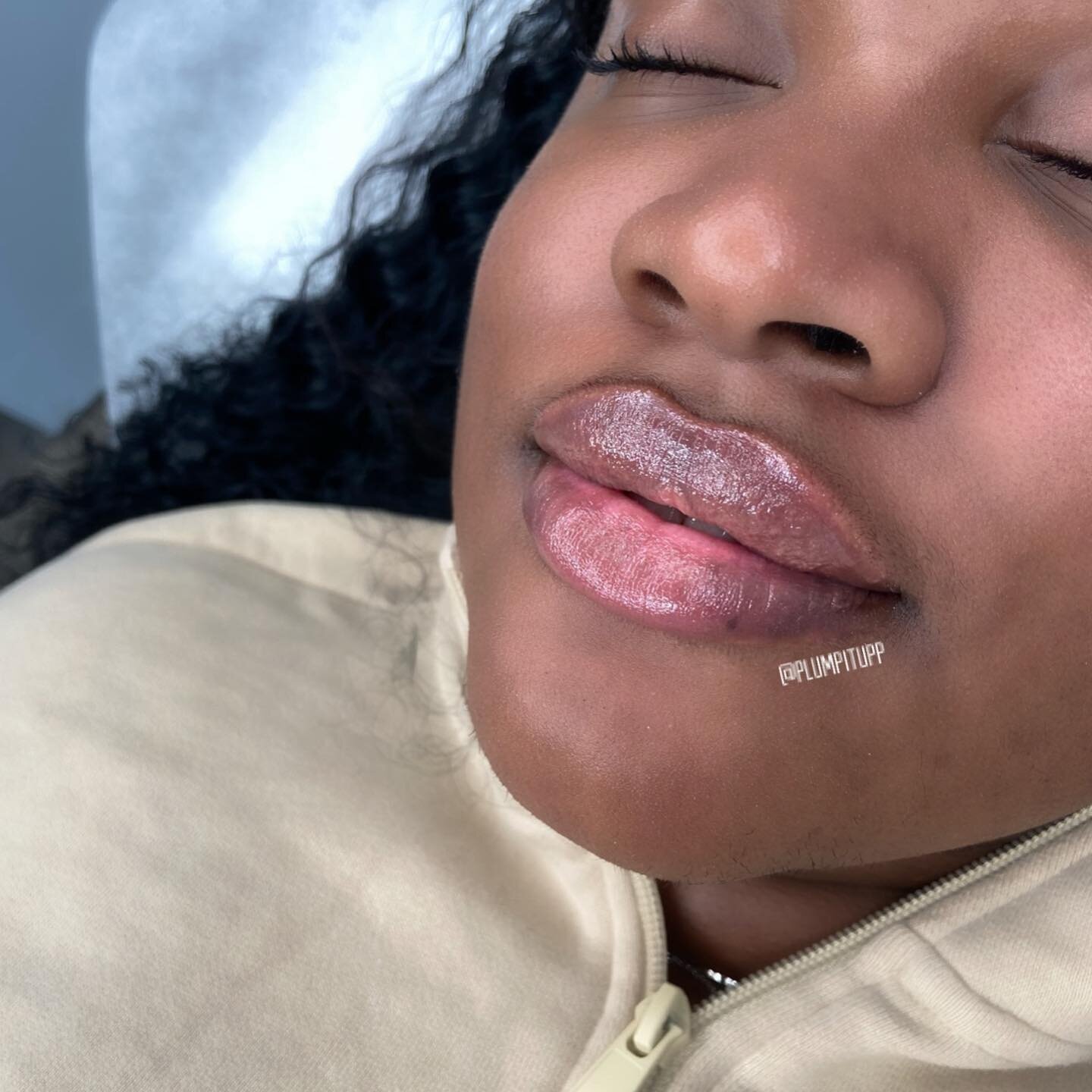 BEAUTY 😭 These gorgeous lips first came to me in 2021 and we were able to achieve beautiful hydration and definition with 1 syringe. Fast forward to her most recent appointment last week - using a Half Syringe to maintain her previous results and co