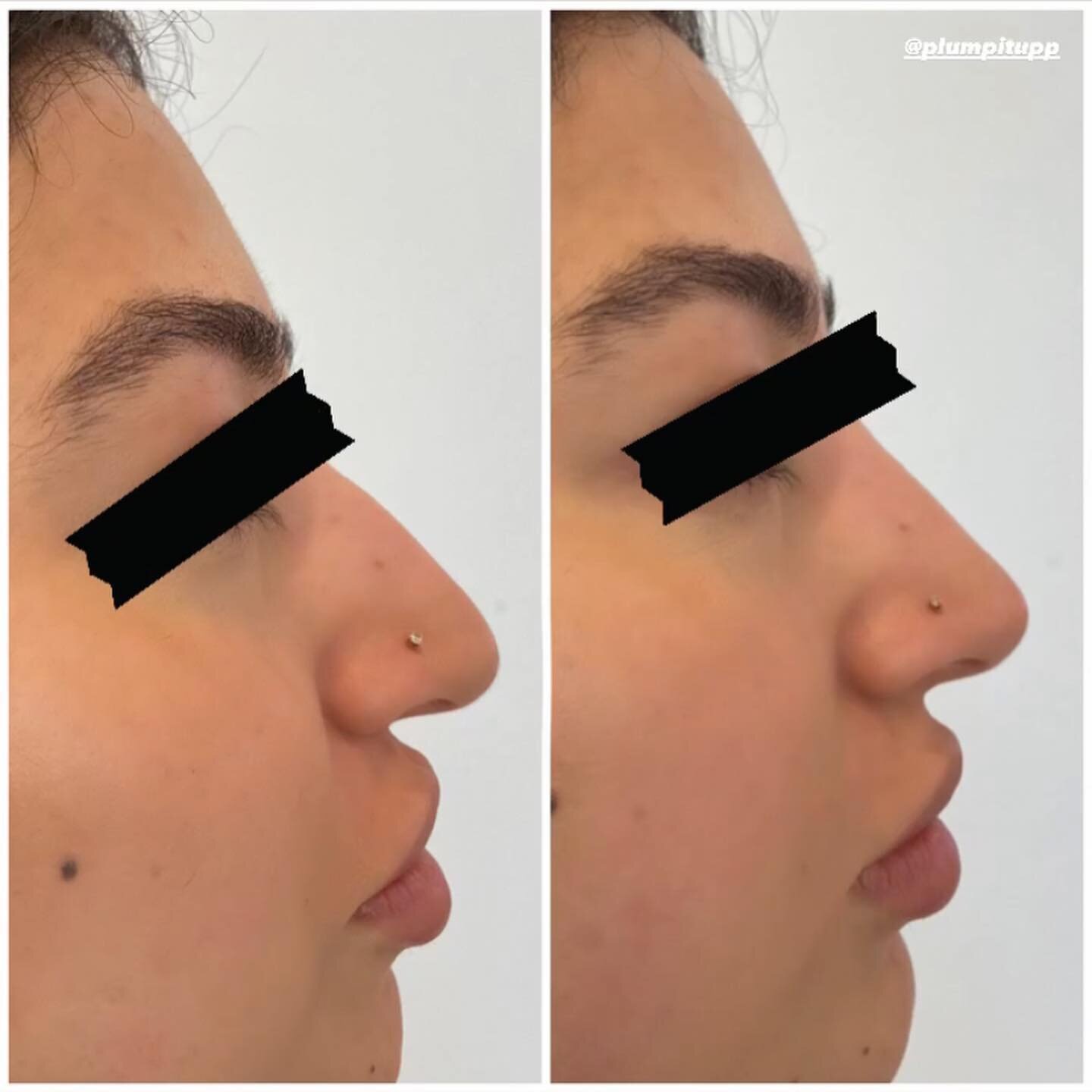 Non surgical rhinoplasty aka Nose Filler !! I am so excited to offer this treatment to my clients. This is something I have been training for for years and to finally give this service to you makes me so happy!! There will be restrictions for who can