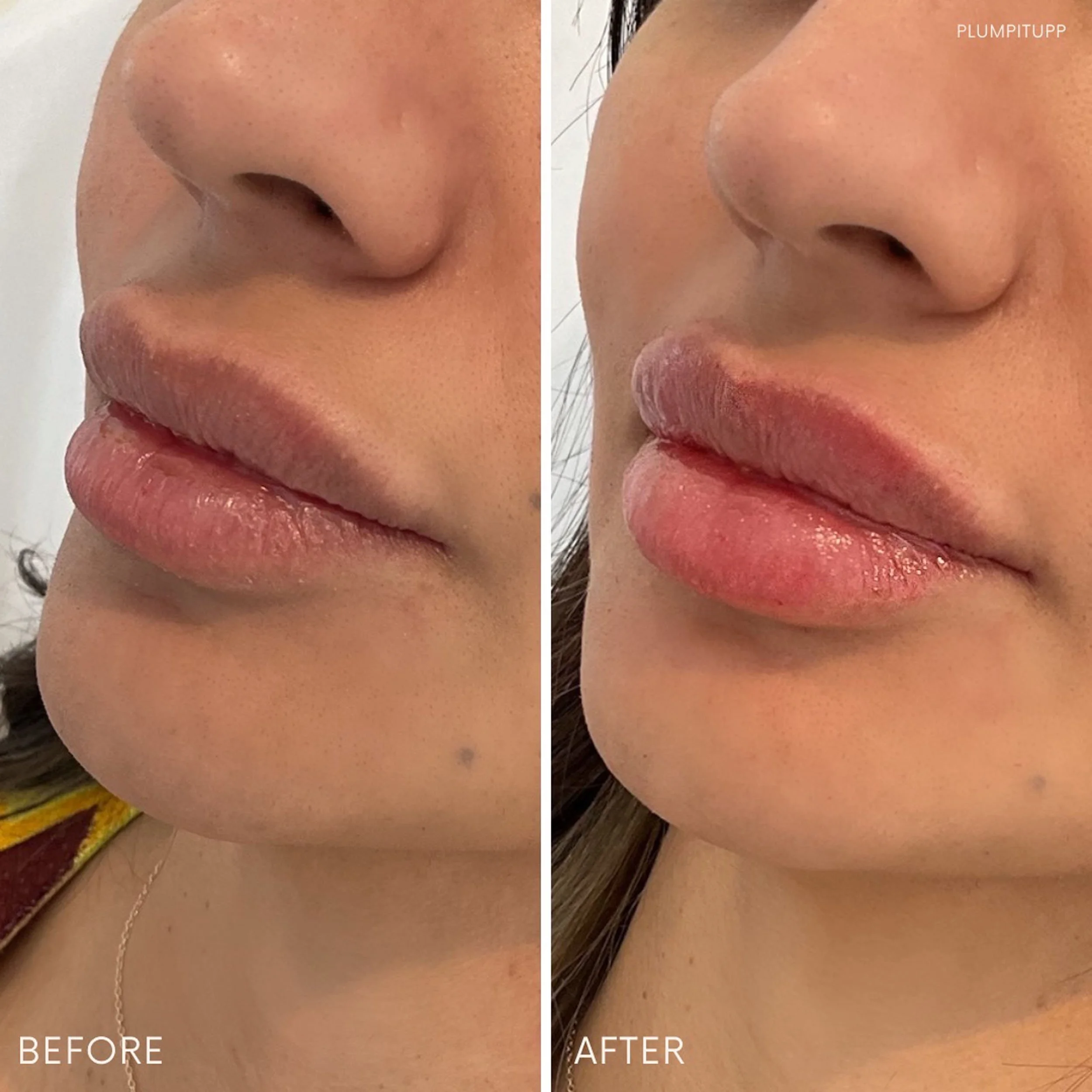 derma-fillers-23.jpg